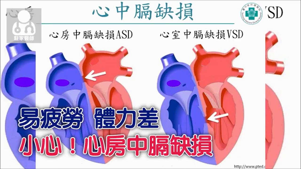 台中榮總-心中膈缺損致先天性心臟病，微創心導管手術效果佳！