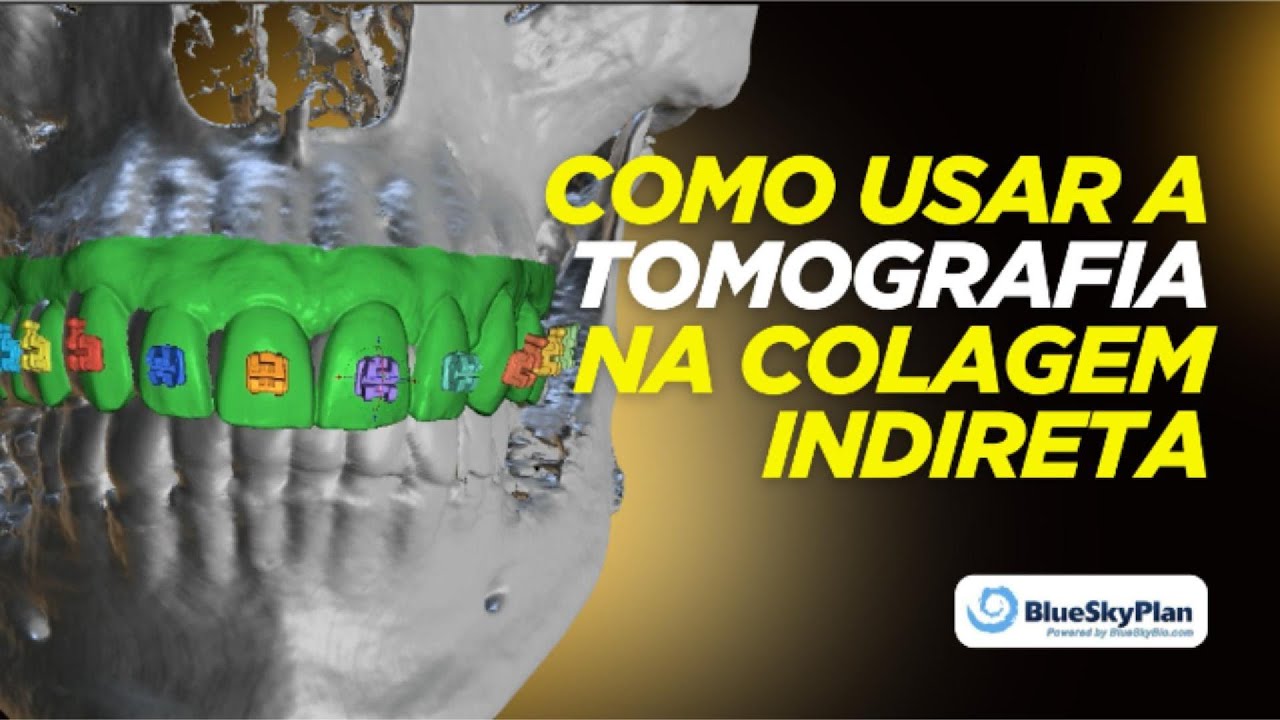 Como Usar a Tomografia no Posicionamento de Brackets – Colagem Indireta com Precisão