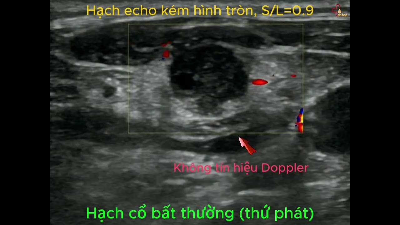 Hạch Cổ Hình Tròn Khá Điển Hình, Hạch Thứ Phát #siêu_âm_mô_mềm