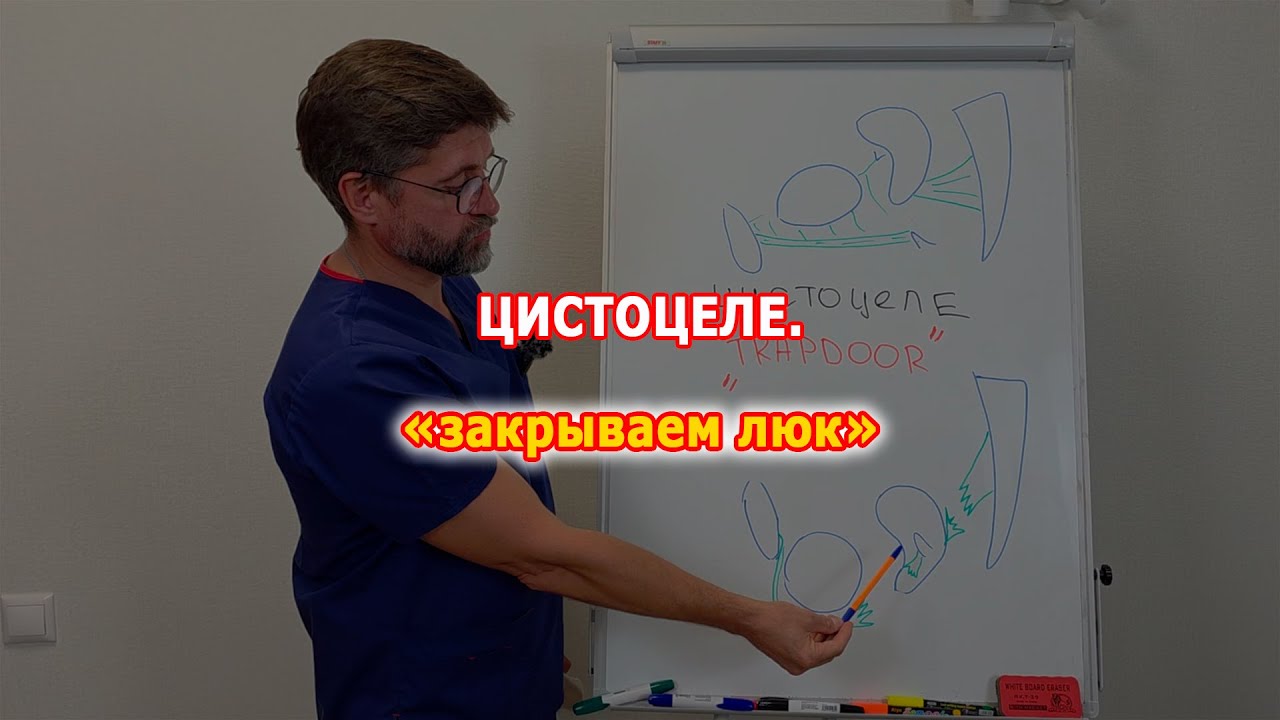 Цистоцеле и TrapDoor. Советы молодым хирургам.