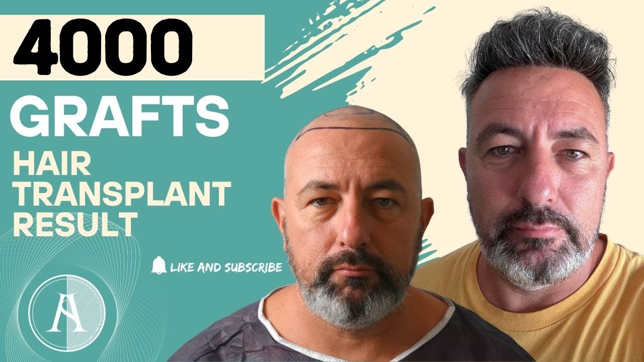 High Density and High Quality Hair Transplant|Injerto Capilar Alta Densidad y Alta Calidad| Sapphire