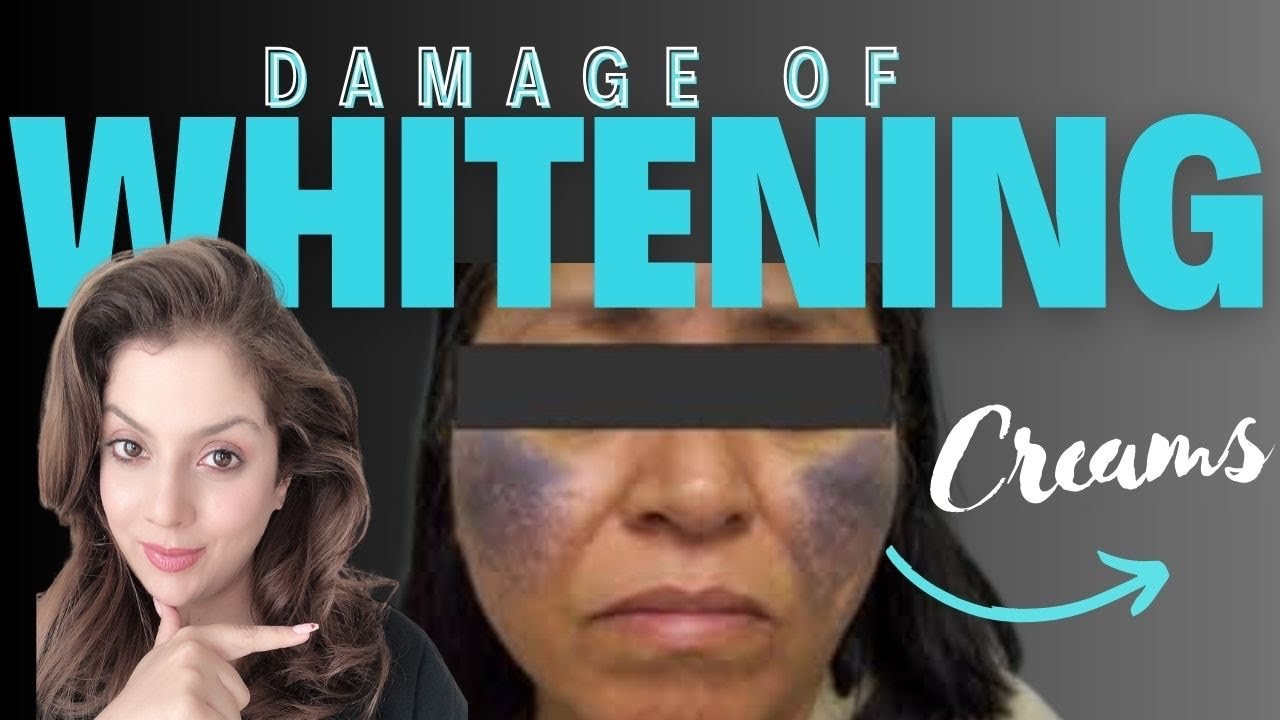 Whitening Creams Destroy Your Skin Forever I Whitening Cream Side Effects