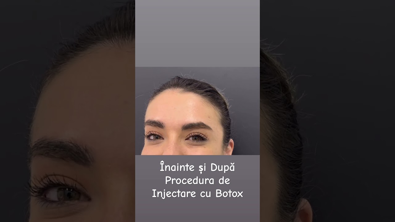 &Icirc;nainte și După Procedura de Injectare cu Botox #botox #procedura #injectare #riduri #antiaging