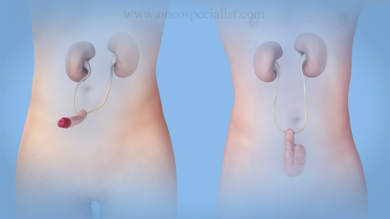 URNARY BLADDER CANCER SURGERY / RADICALCYSTECTOMY ANIMATION BY DR VIMALATHITHAN