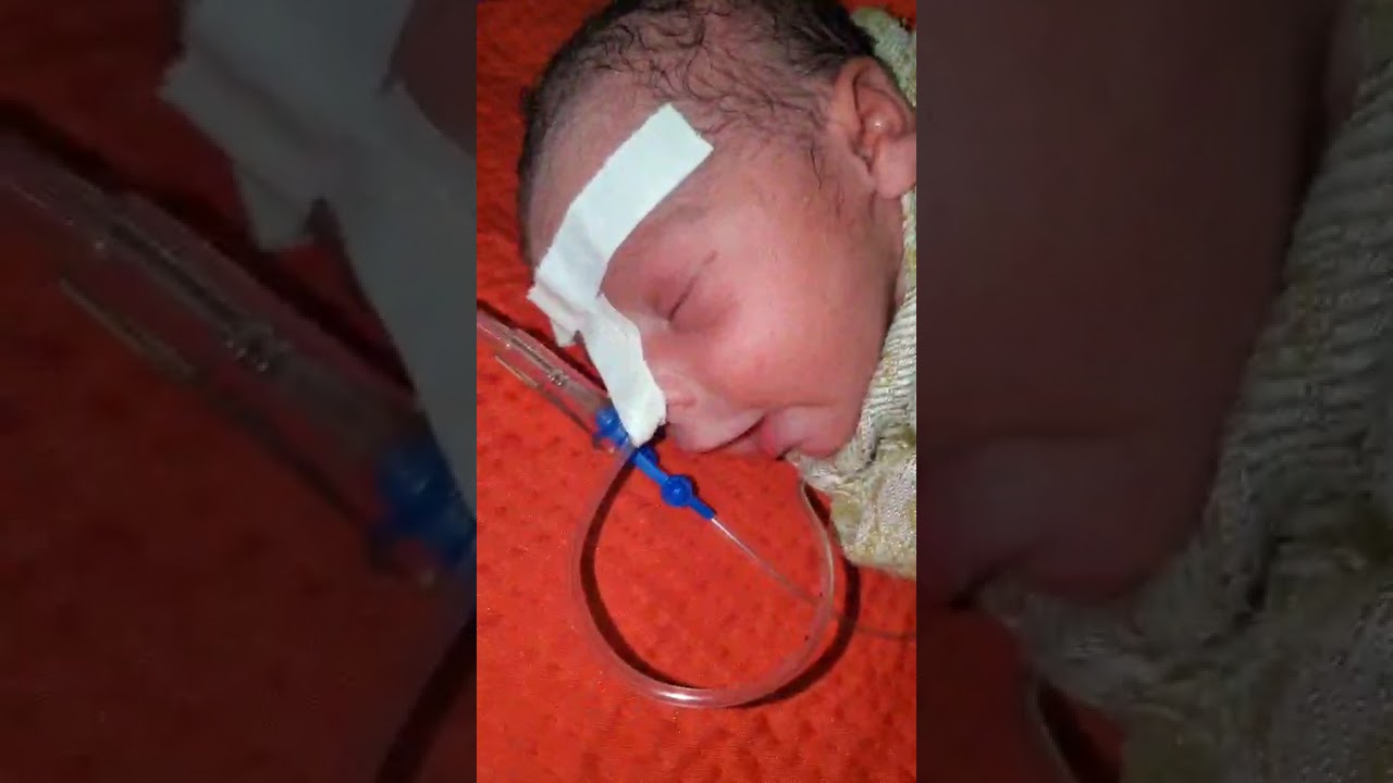 Newborn Baby mouth open After Birth Doctor Inserts Tube Through Mouth Lung Breathing Support