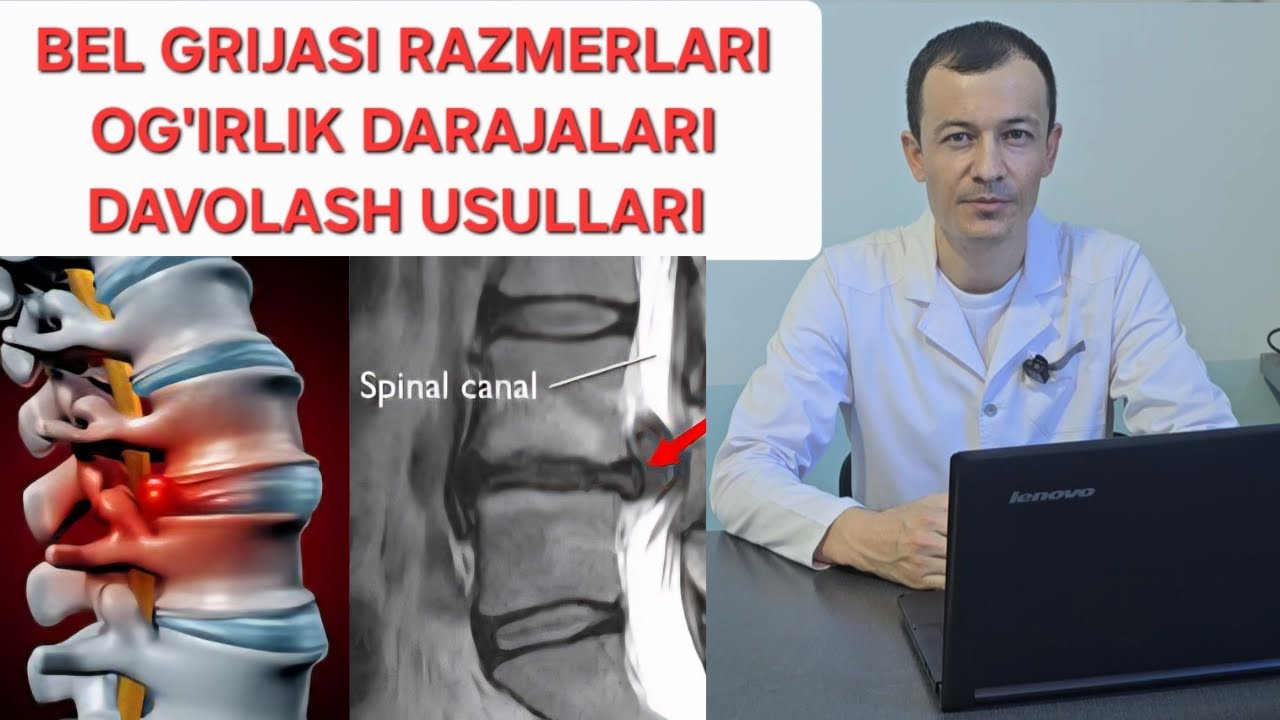 BEL GRIJASI RAZMERLARI VA DAVOLASH #mardonbekgafurov