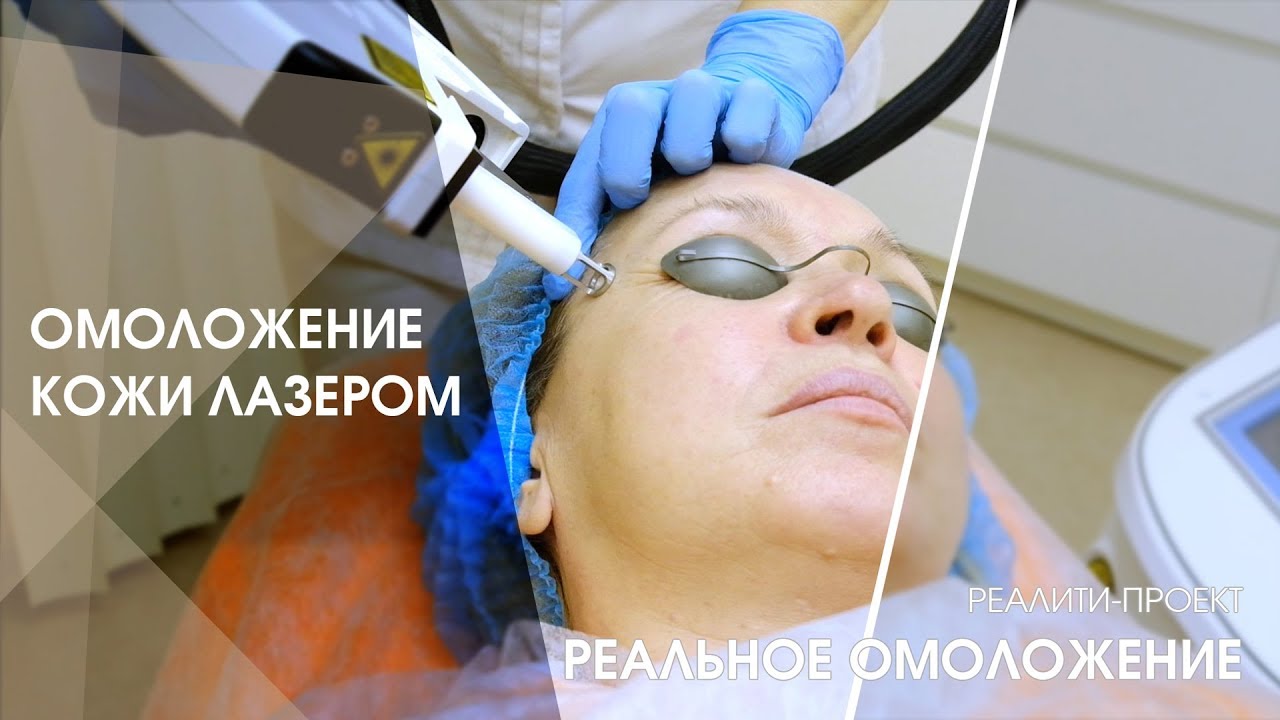 Омоложение КОЖИ лазером / Лазерное омоложение RecoSMA