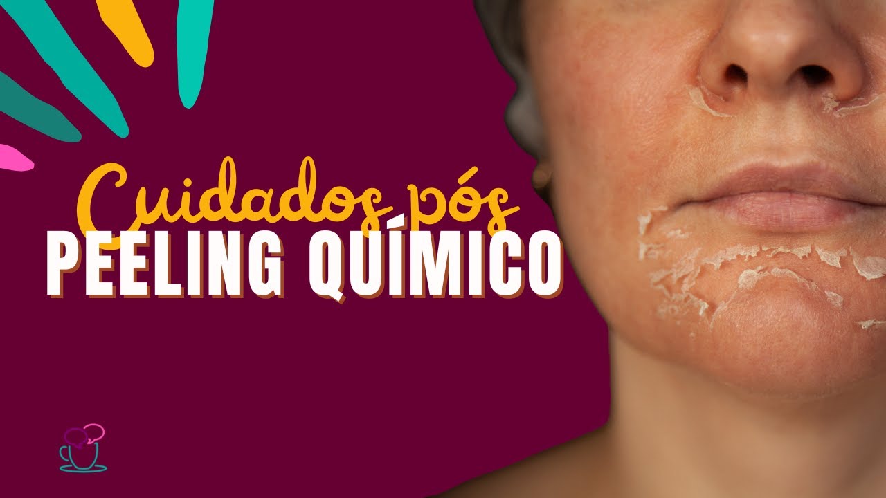 Cuidados após Peeling Químico! | O Que Fazer e Não Fazer na pele após a sessão?