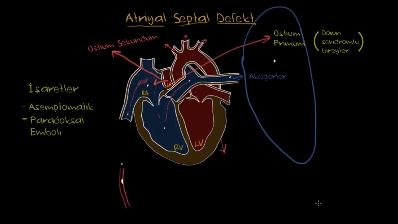 Atriyal Septal Defekt (Fen Bilimleri) (Sağlık ve Tıp)