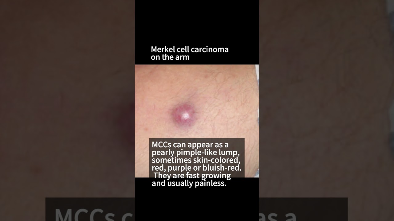 What does Skin Cancer look like? Merkel Cell Carcinoma #skincare #skincancer #cancer
