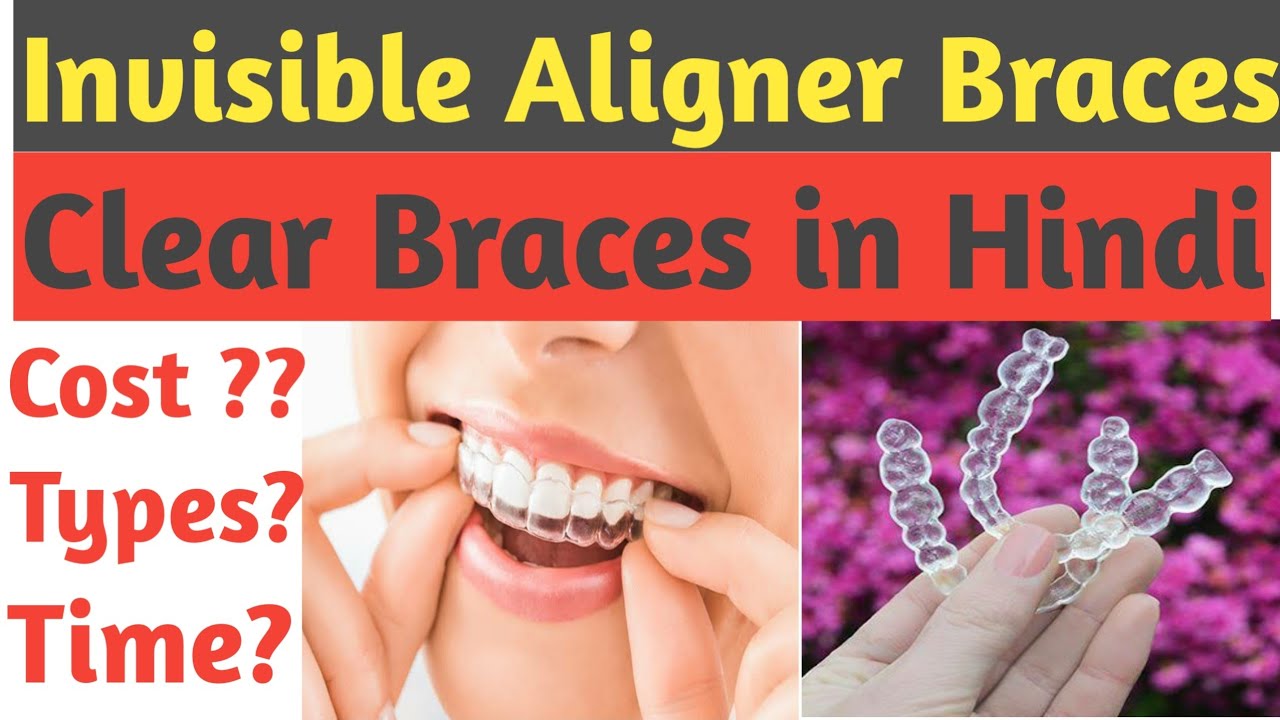 Invisible Aligner Braces |Clear Braces Treatment Hindi | Invisalign Cost, Time & Procedure