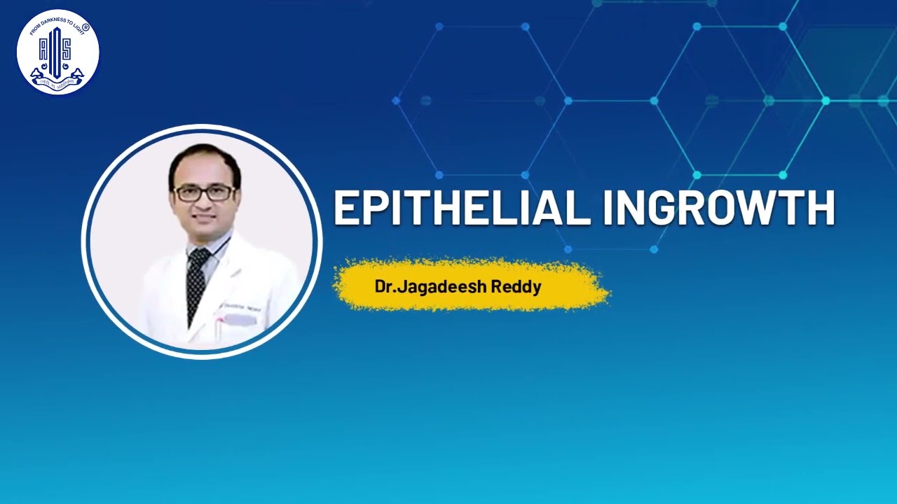 Врастание эпителия &ndash; доктор Джагадиш Редди