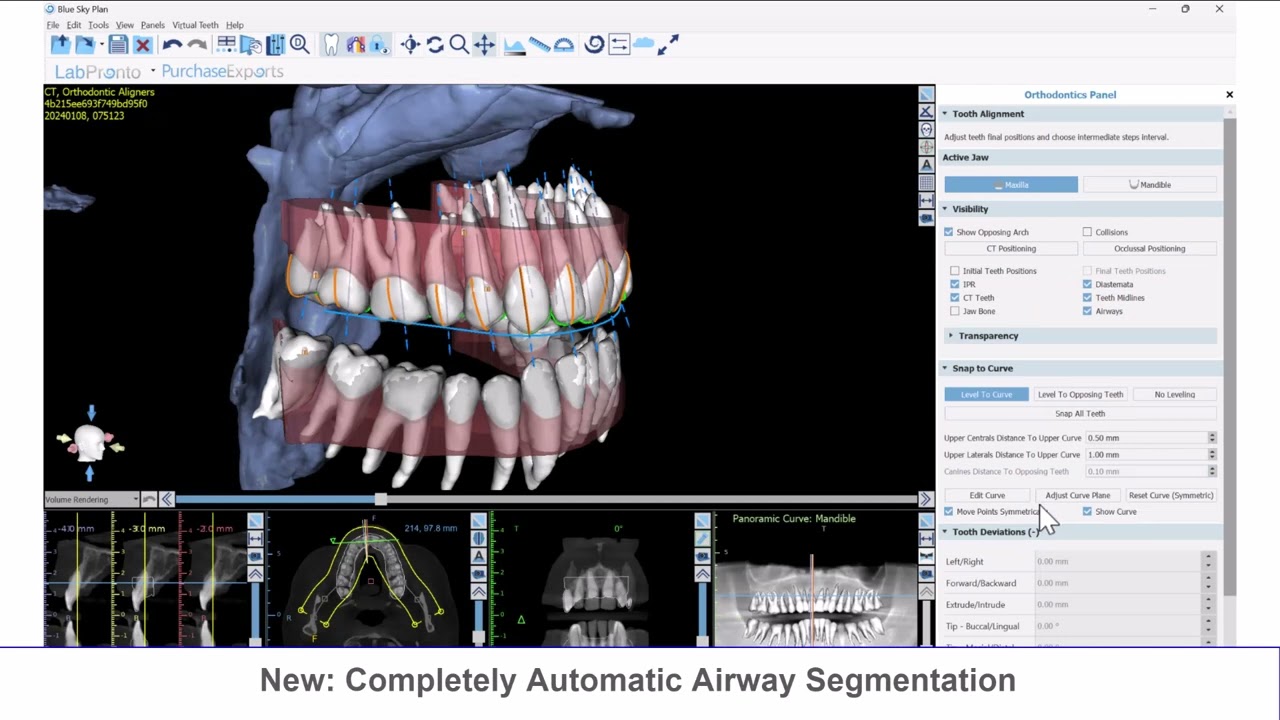 BSP V4.13: New Orthodontic Aligner Functionality Explained!