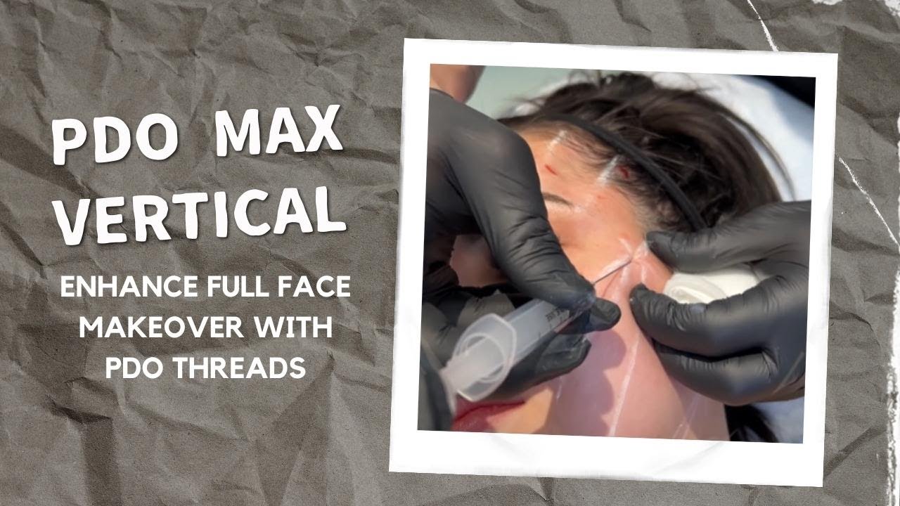 PDO MAX VERTICAL ENHANCE FULL FACE MAKEOVER WITH PDO THREADS | PATIENT STORY | Dr. Jason Emer