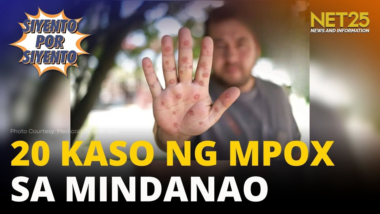 20 kaso ng MPOX naitala sa Mindanao; DOH nagbabala