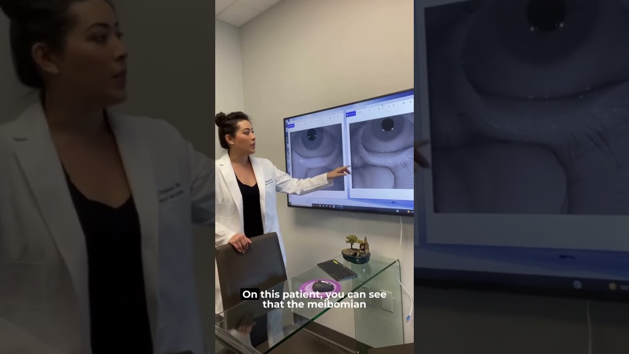 What are Meibomian Glands?