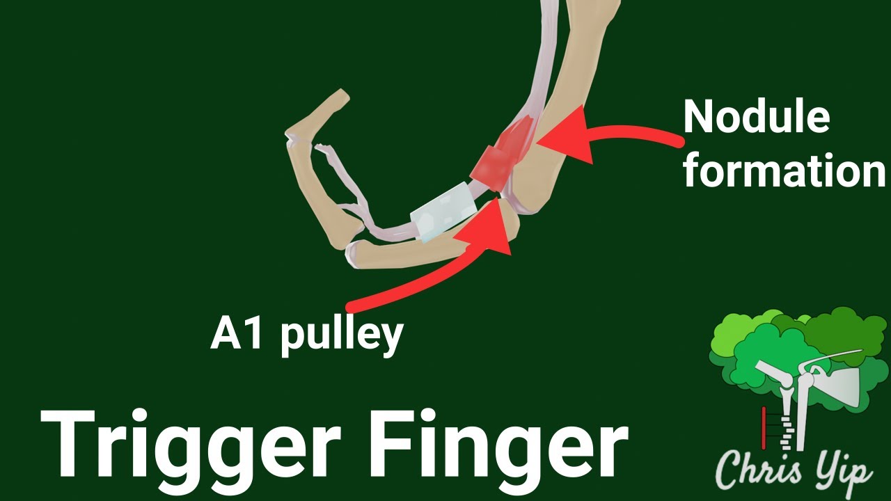 Pathophysiology of Trigger Finger (animated)