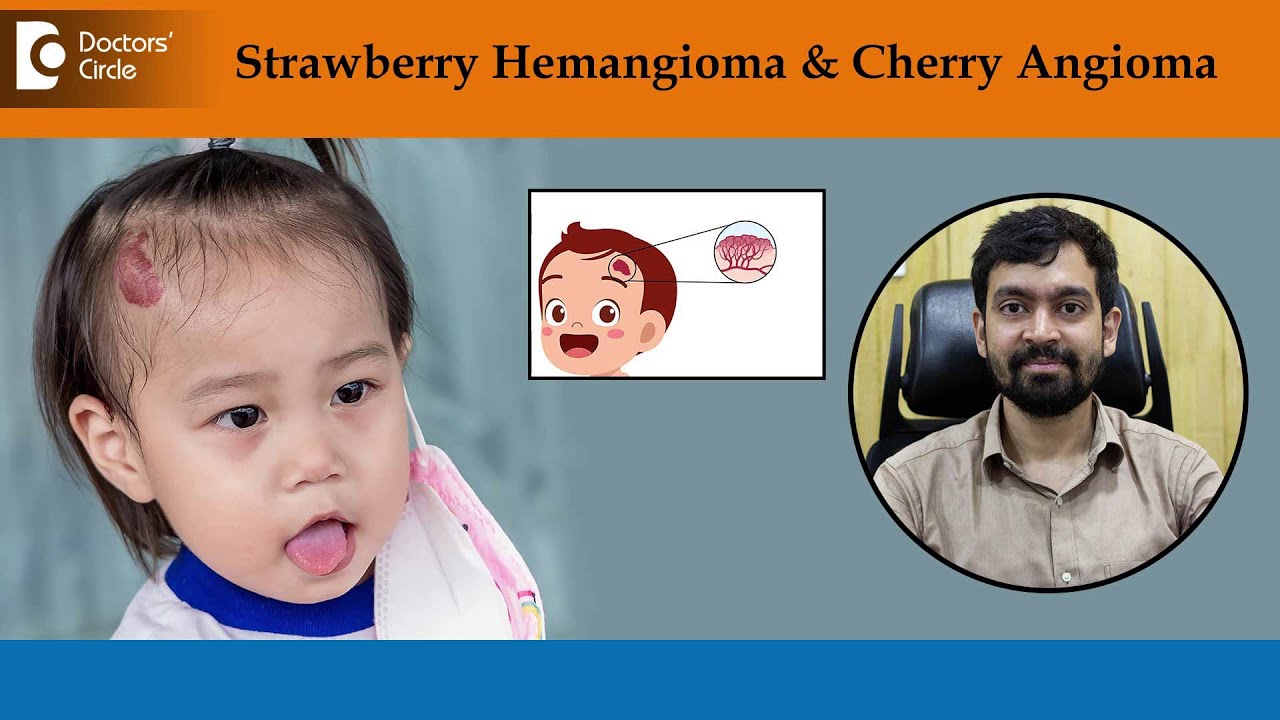 Bright Red Birthmark|What is Strawberry Hemangioma & Cherry Angioma-DrRajdeep Mysore|Doctors' Circle