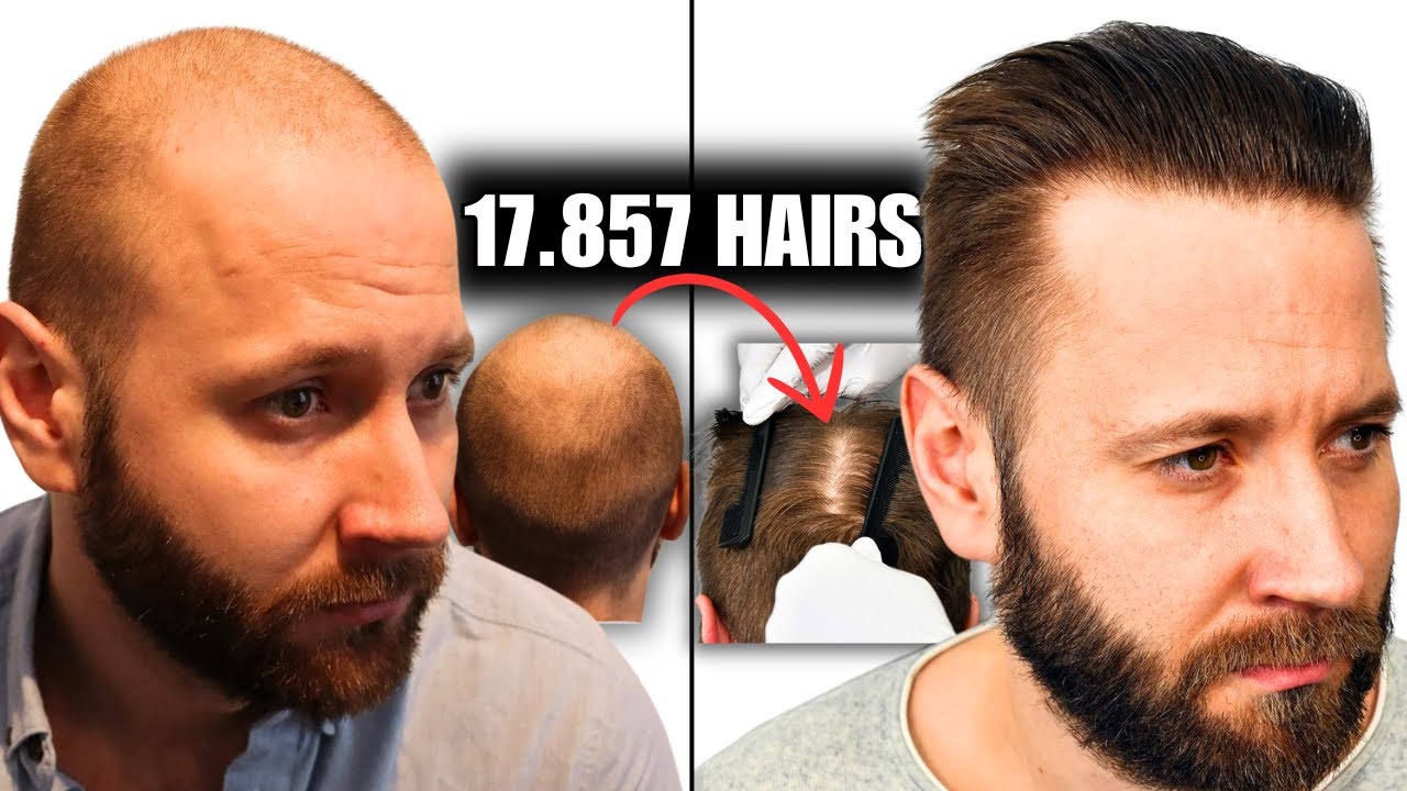 Did I Find The Best Hair Transplant Surgeon in Scandinavia? Dr. Emil George