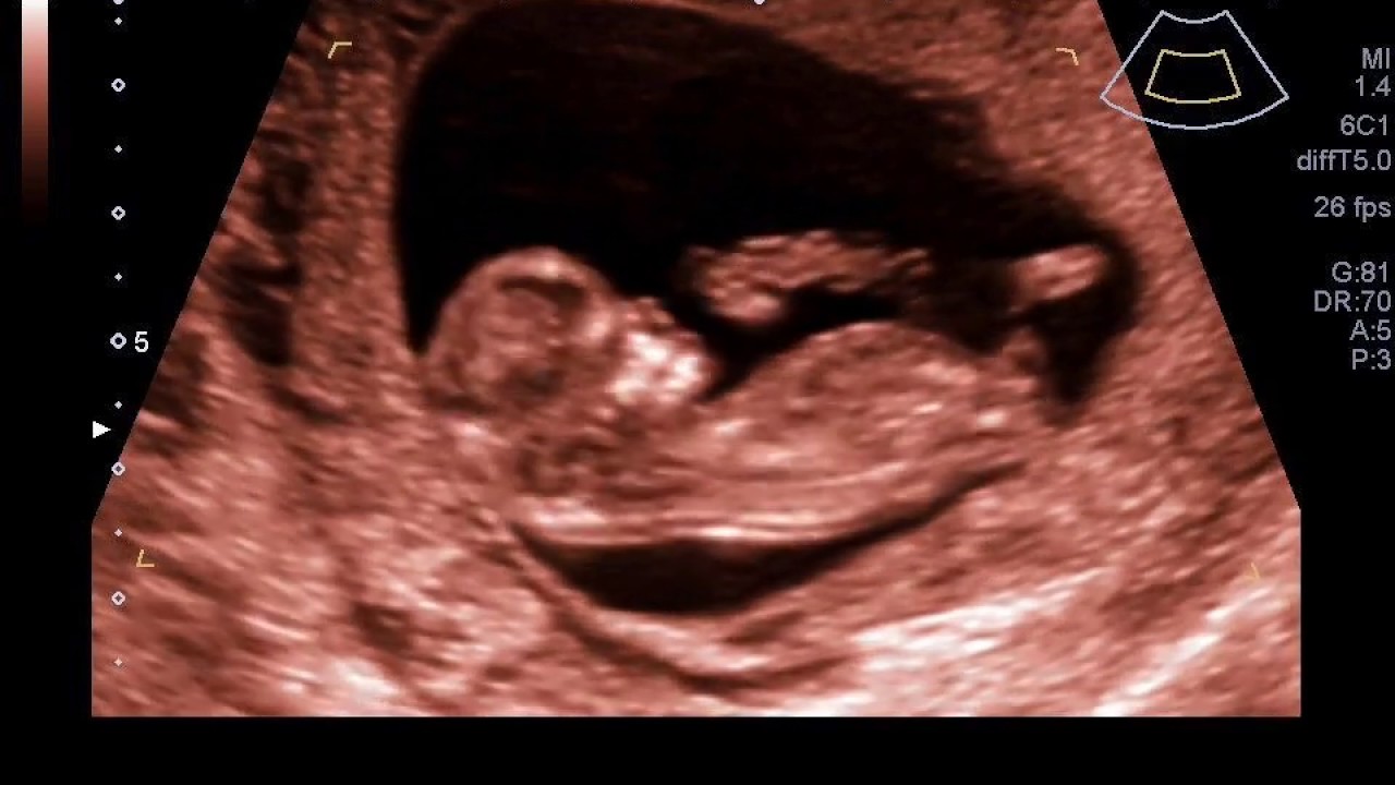 Echo 11 weken bij Verloskundigen de Oorsprong Nijkerk