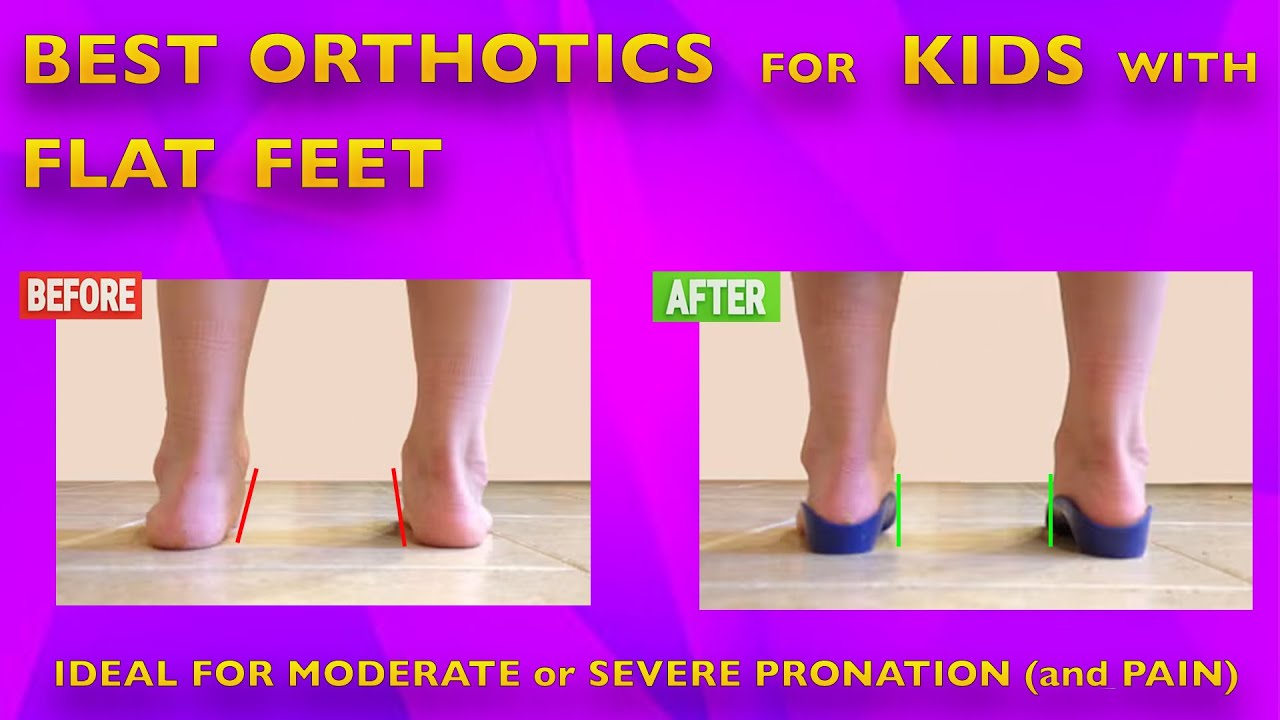 Top Orthotics for Kids’ Flat Feet | Ideal Support for Moderate to Strong Pronation and Pain