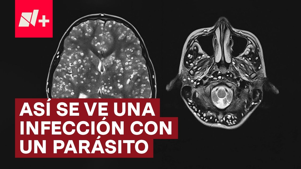 &iquest;C&oacute;mo se ve la Cisticercosis, enfermedad mortal? - N+