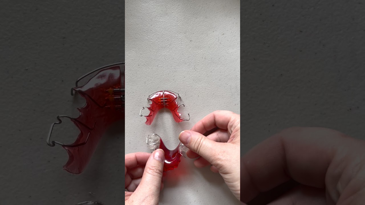 Posterior Bite Plates / RPE/ Expander