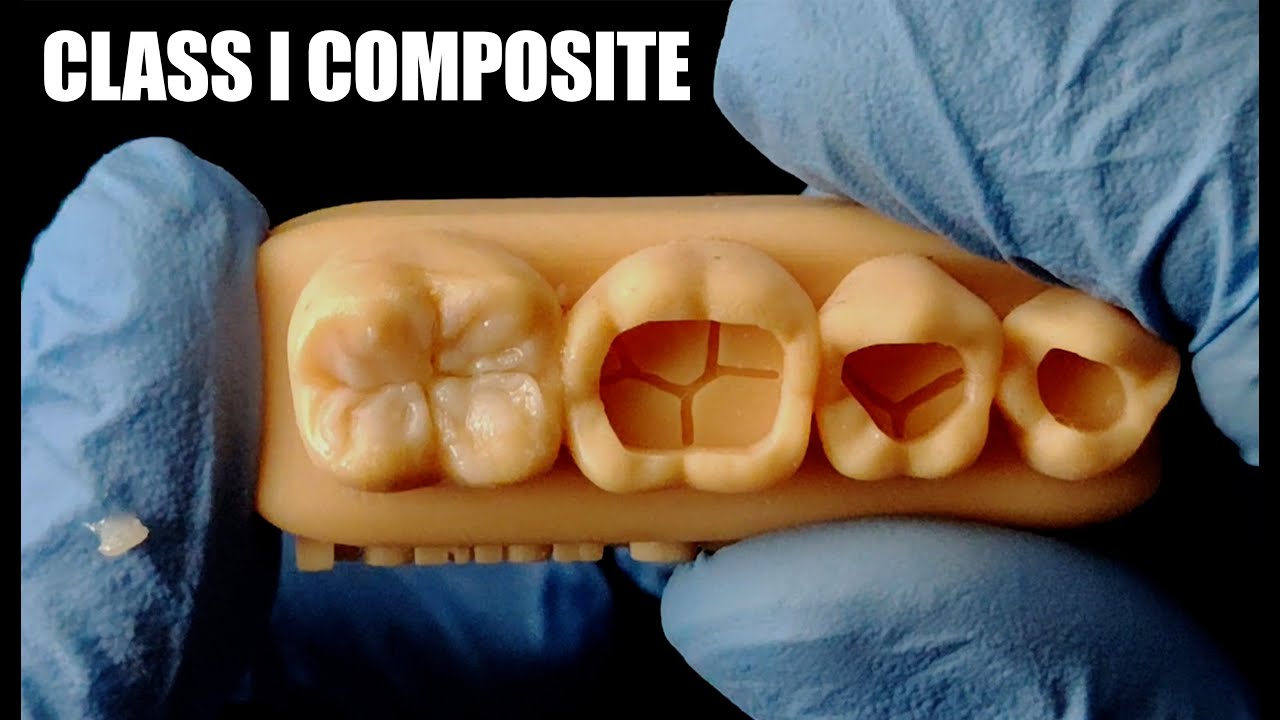 CLASS I COMPOSITE - اسهل طريقة لعمل حشوة الكومبزت ( الحشوة الضوئية )