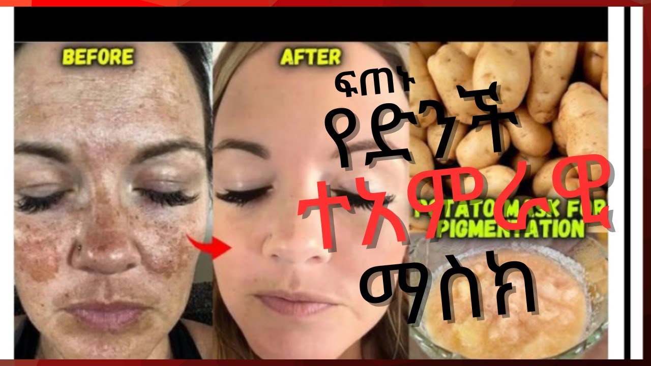 በድንች🥔፣ ማር🍯 እና ሎሚ🍋 ጥቋቁር ነጠብጣብና ማድያትን (Hyperpigmentation) በሳምንት ውስጥ አስወግዱ! | 100% ውጤታማ የተፈጥሮ ማስክ
