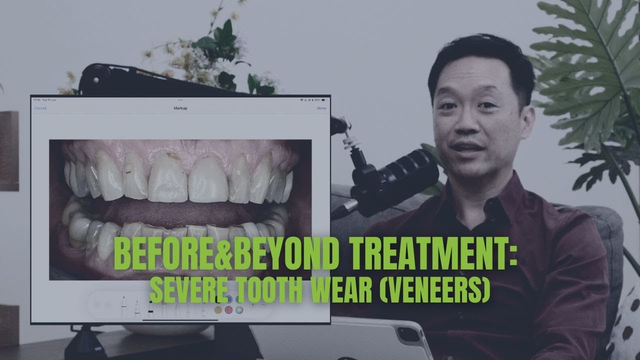 Severe Tooth Wear?! (VENEERS)  | BEFORE & BEYOND EP7