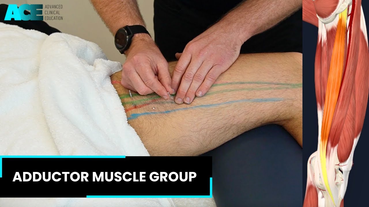 Dry Needling: Adductor Muscle group