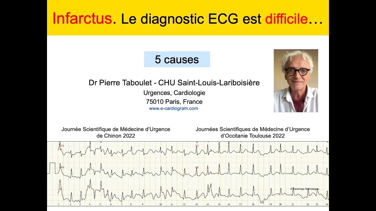 8h. Infarctus. Pourquoi le diagnostic ECG est difficile? P Taboulet