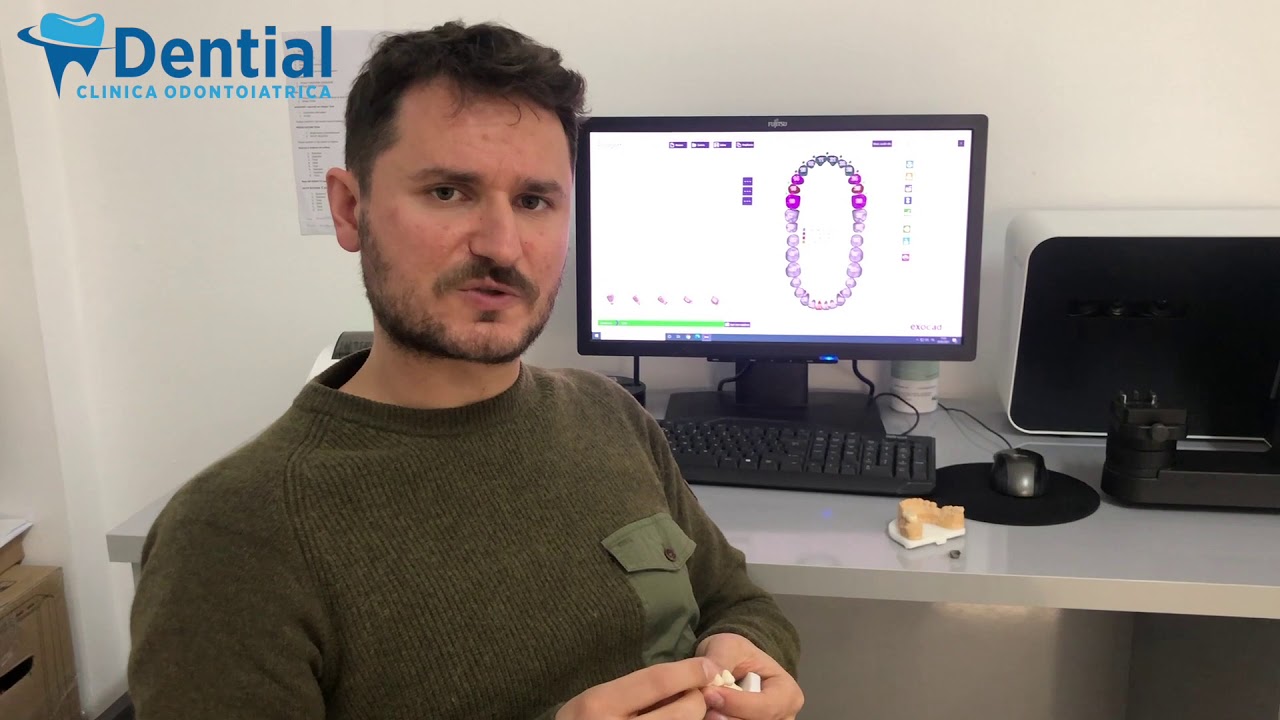 Capsule dentali in metallo ceramica e corone in zirconio
