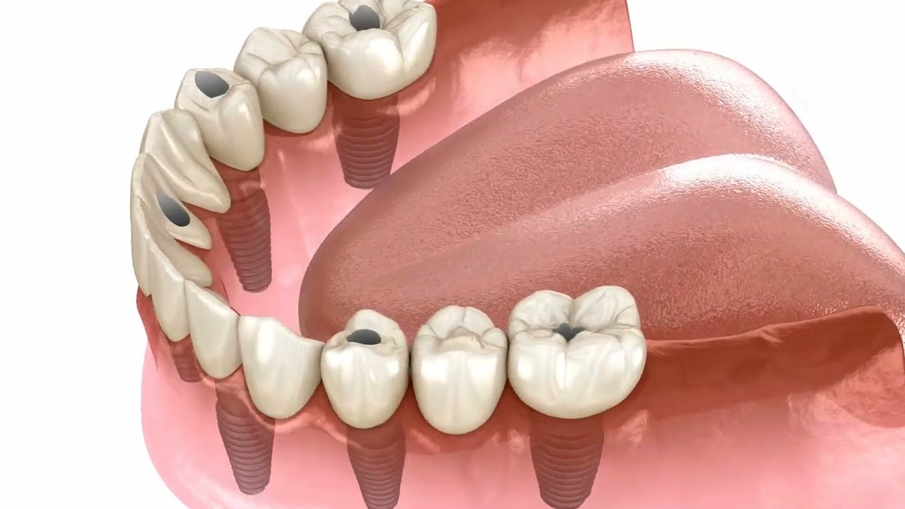 Fogbe&uuml;ltet&eacute;s, 6 implant&aacute;tumon r&ouml;gz&iacute;tett teljes als&oacute; fix fogsor