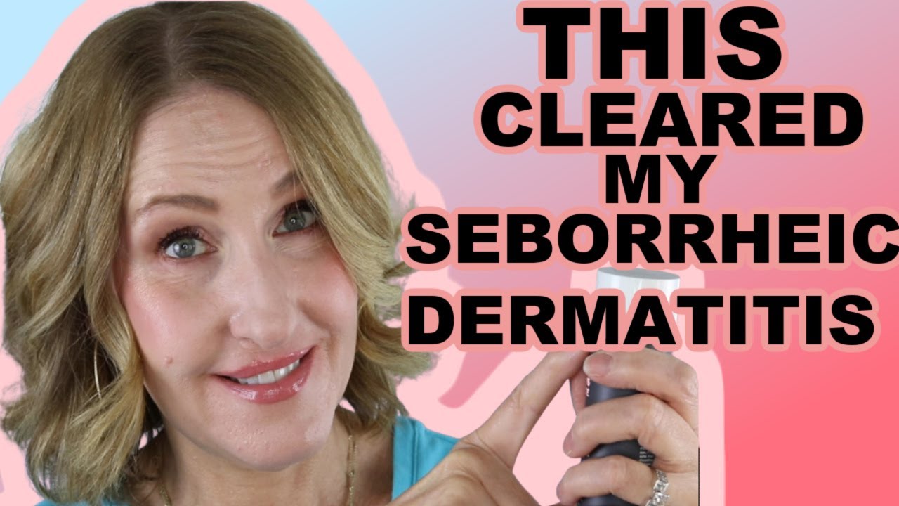 HOW I CLEARED UP MY SEBORRHEIC DERMATITIS