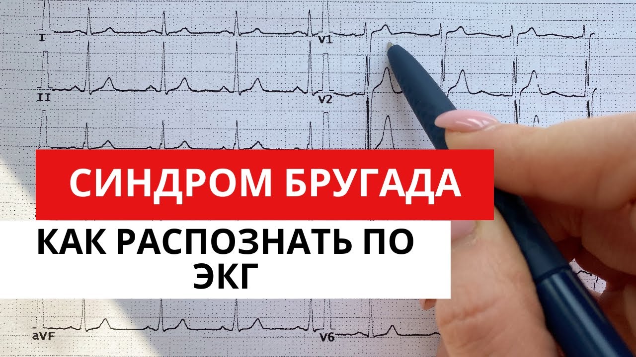 ЭКГ диагностика синдрома Бругада. Диф. диагностика подъема сегмента ST  на ЭКГ.