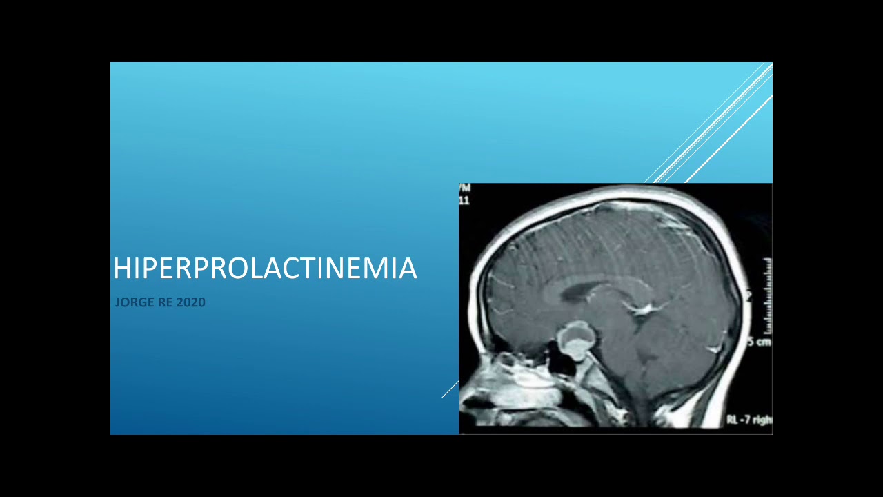 Hiperprolactinemia (Tumor hipofisario)