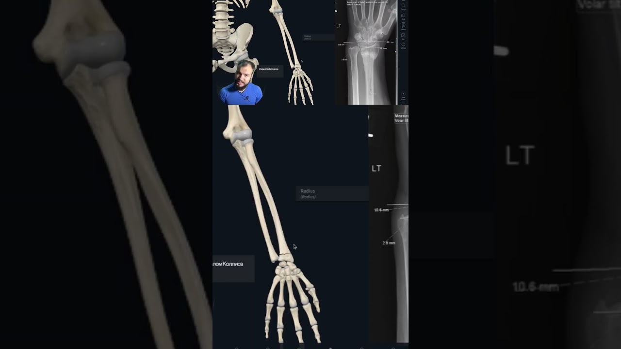 Перелом Лучевой кости #биология #доктор #медицина #анатомия #врач #anatomy