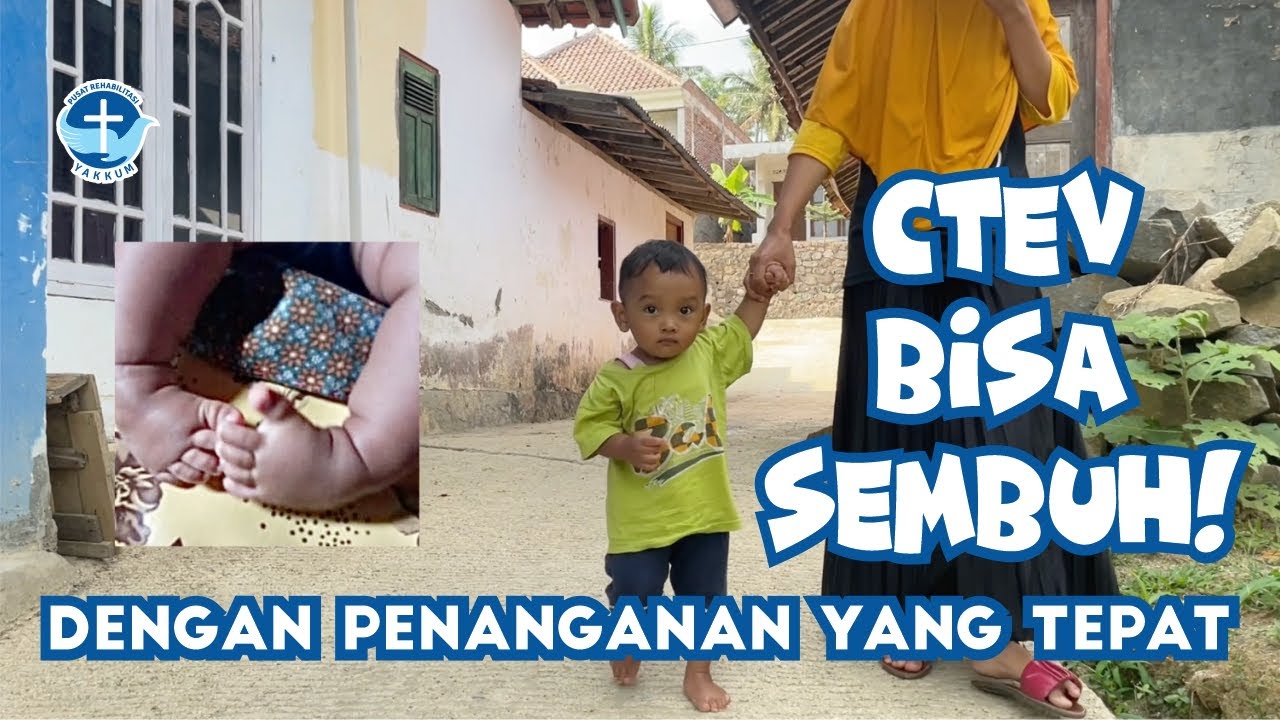 CLUBFOOT/KAKI PENGKOR BISA SEMBUH DENGAN PENANGANAN YANG TEPAT!