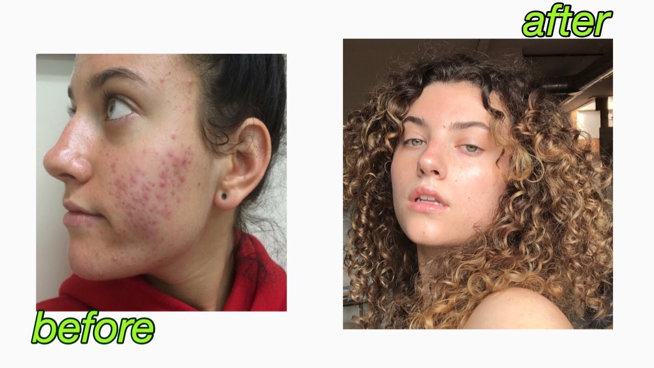 my POST-ACCUTANE morning + night skin care routine (for combination skin)