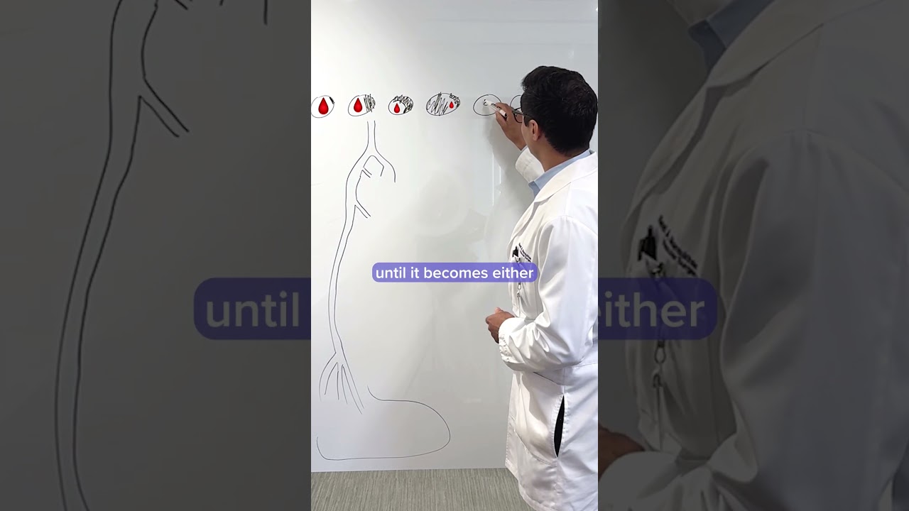 What Is Peripheral Vascular Disease?