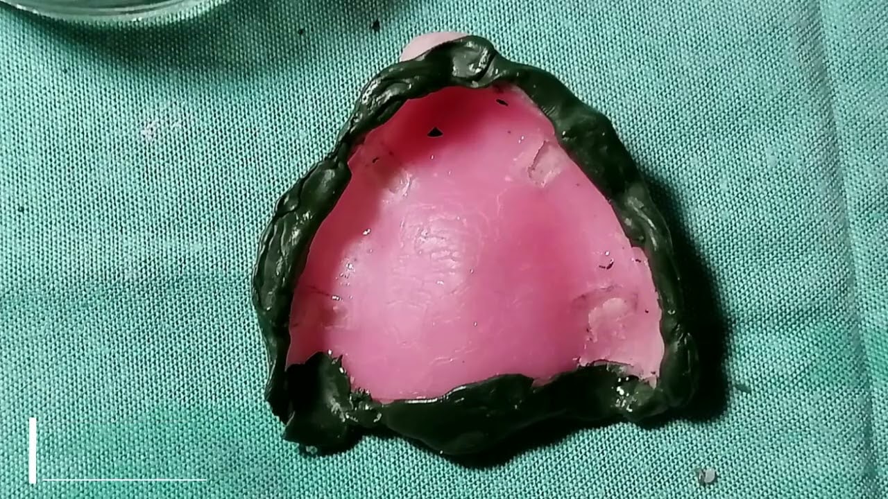 ENCAJONADO PROTESIS TOTAL  FOUSAC