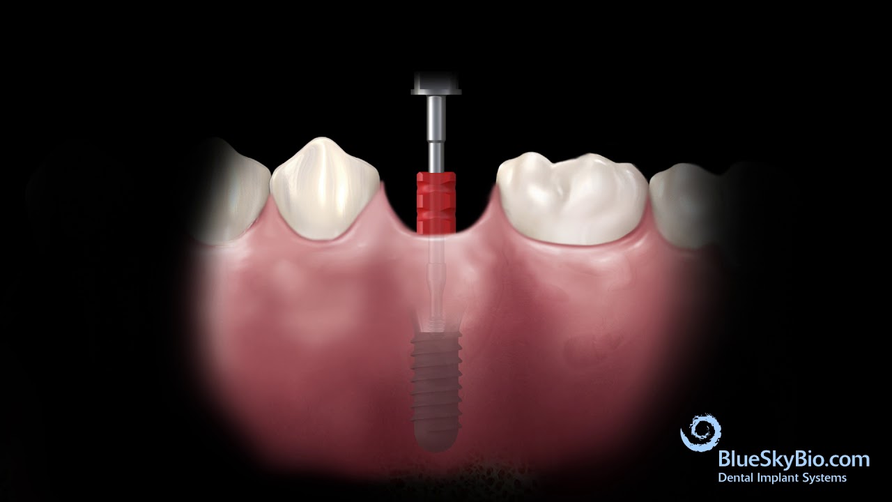 Tissue Level implant and UCLA Abutment