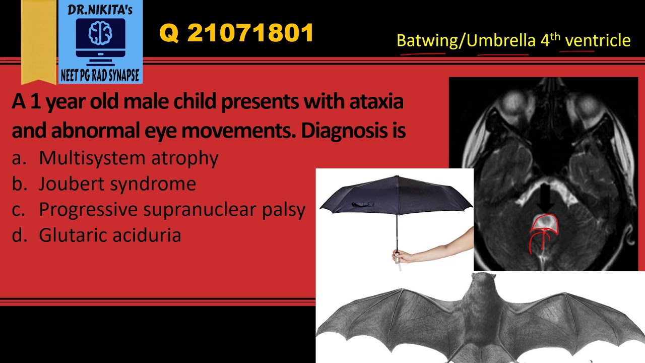 Joubert syndrome- Synopsis
