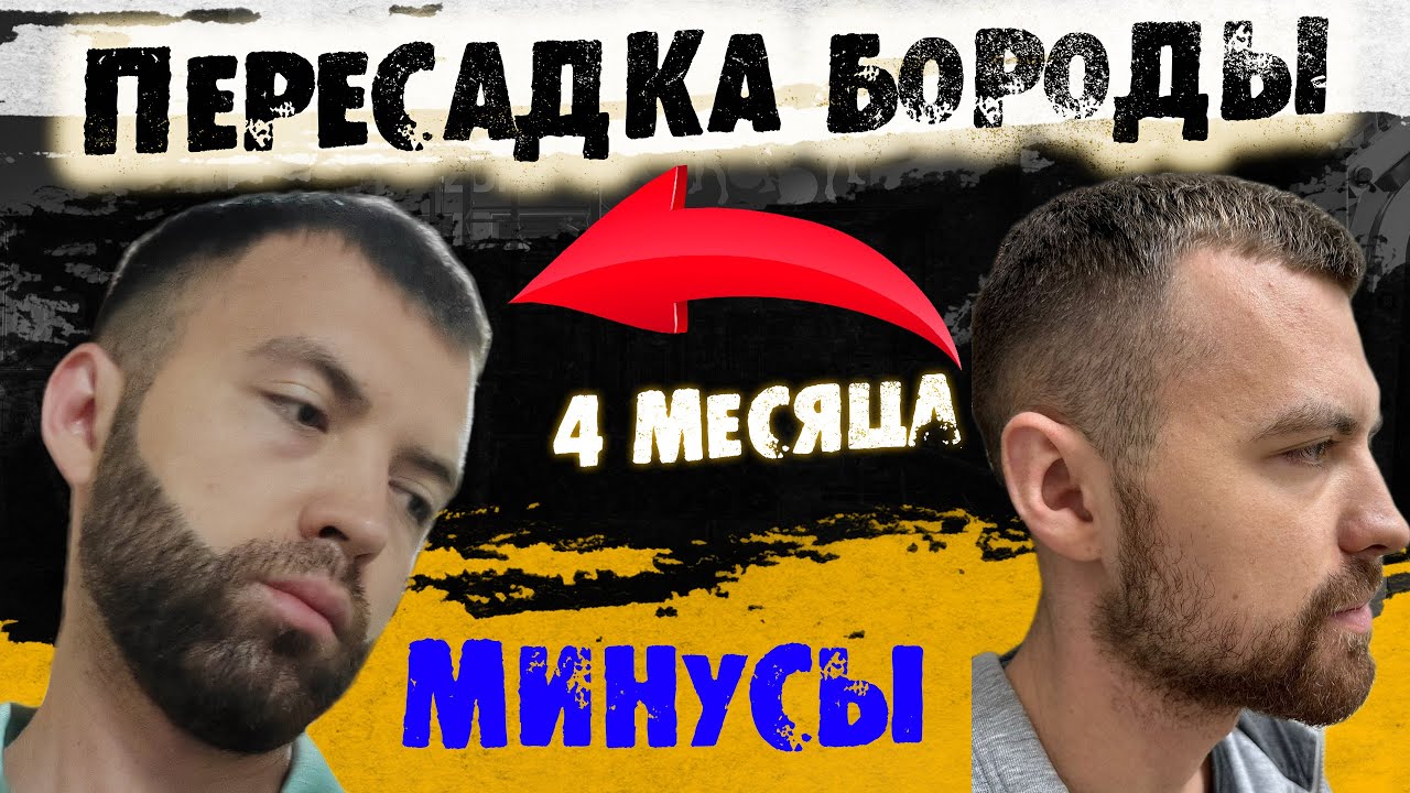 Посмотри это видео пока не сделал ПЕРЕСАДКУ БОРОДЫ / Андрей Борода Выпуск №30