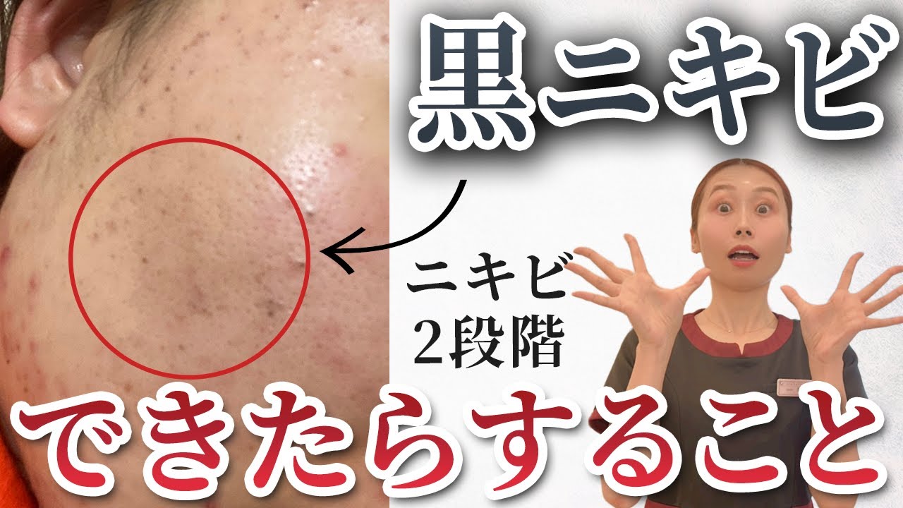 【ニキビタイプ別②】黒ニキビを放置するとヤバイ理由。