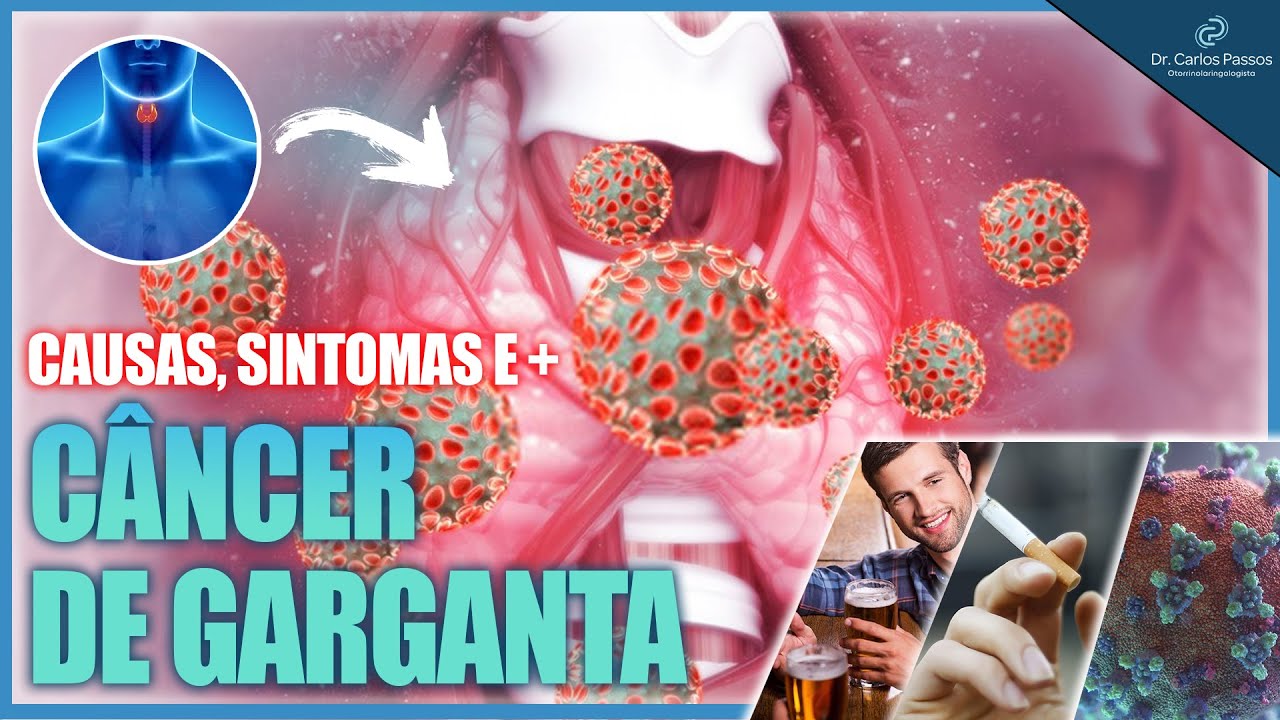 Câncer de Garganta. Sintomas, causas e mais!