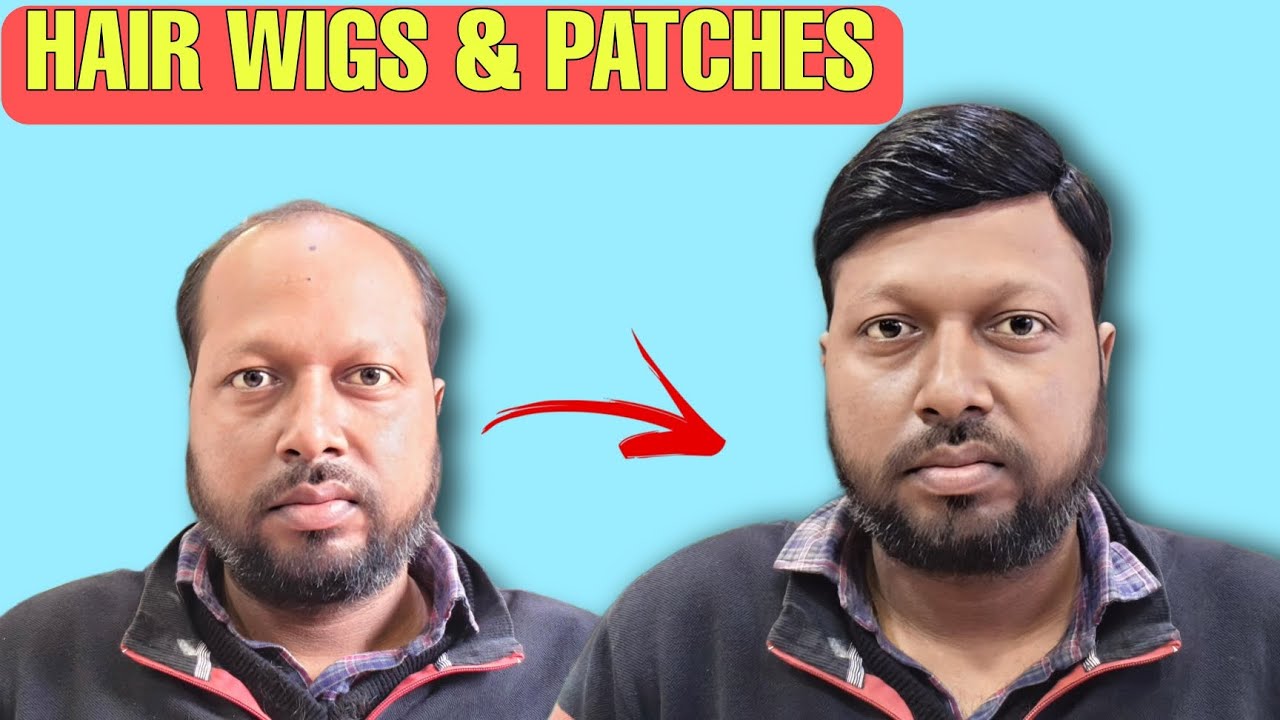 Permanent Hair Patch for Men | Non-surgical Hair transformation | गंजापन दूर करें मात्र 1 घंटे में