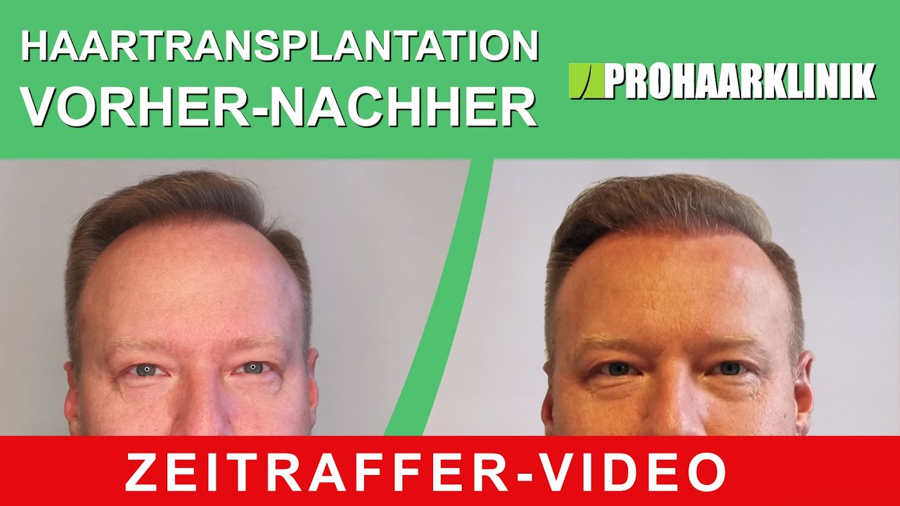Haartransplantation vorher nachher: Pavel (Zeitraffer-video) - PROHAARKLINIK