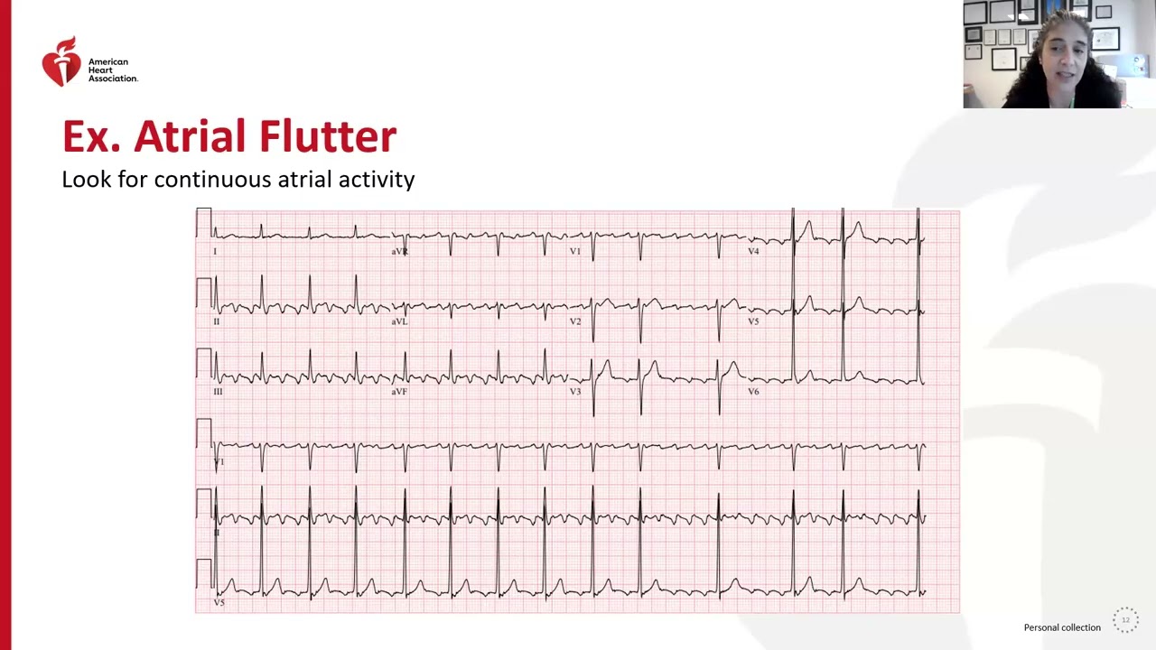 Supraventricular Tachycardia: Mechanisms and Clinical Presentations